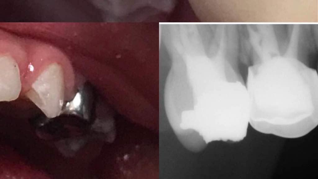 نمونه ای از عصب کشی وروکش استیل برای دندانهای بشدت تخریب شده