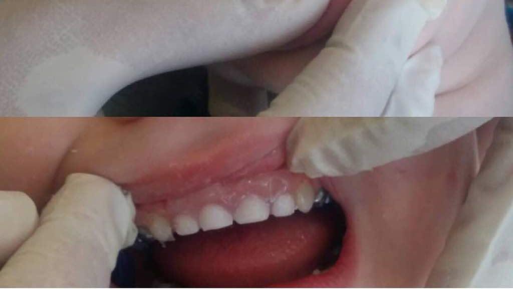 پلاک دنداندار برای کودکی همه دندانهای جلو را از دست داده است