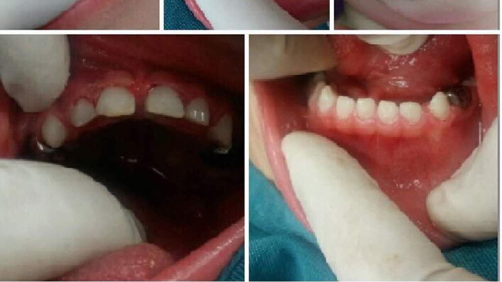 کودکی که تحت بیهوشی در. بیمارستان  تمام دندانهایش عصب کشی  و ترمیم شدند.