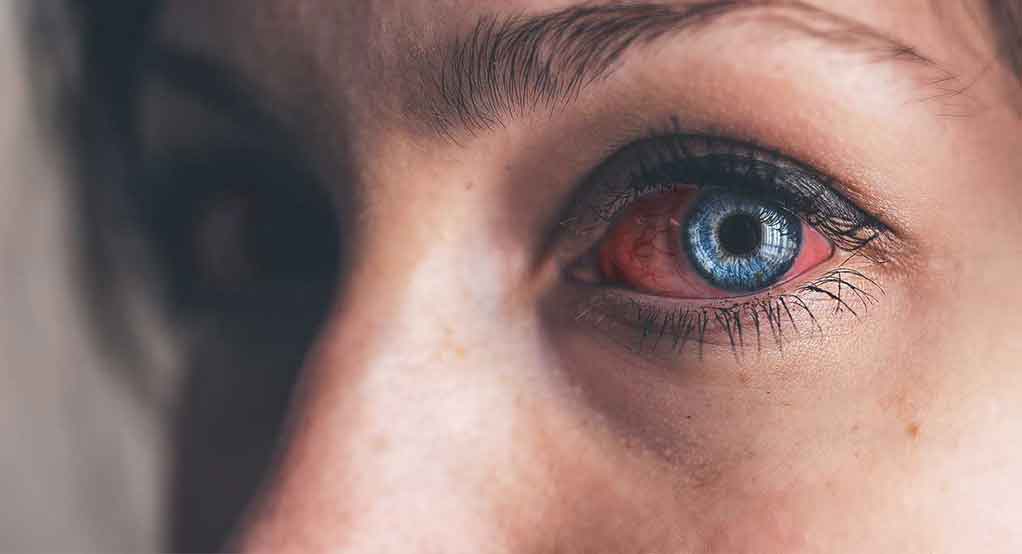 چگونه از عفونت چشم ها در هنگام استفاده از لنز جلوگیری کنیم ؟ چگونه از عفونت چشم ها در هنگام استفاده از لنز جلوگیری کنیم ؟