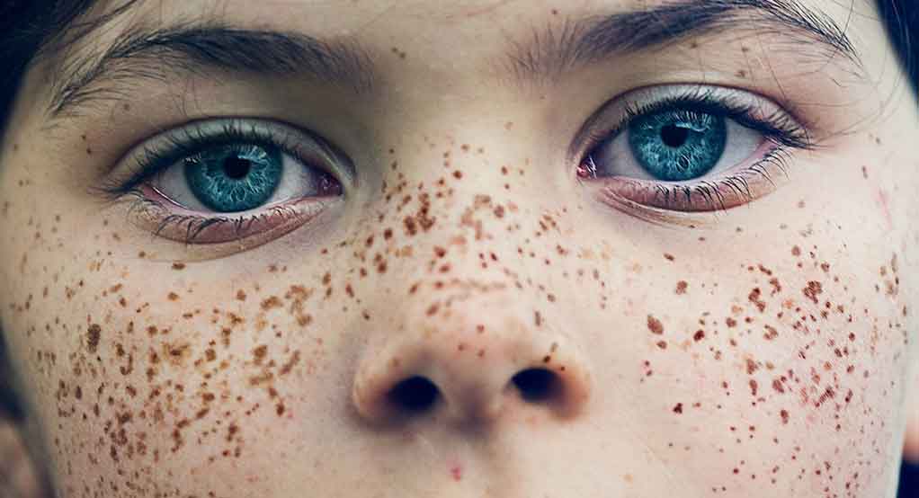 چگونه لک های صورت خود را درمان کنیم؟ چگونه لک های صورت خود را درمان کنیم؟