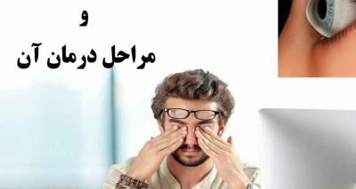 قوز قرنیه و مراحل درمان آن