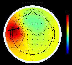 نقشه برداری صرع (Seizure Mapping) نقشه برداری صرع (Seizure Mapping)