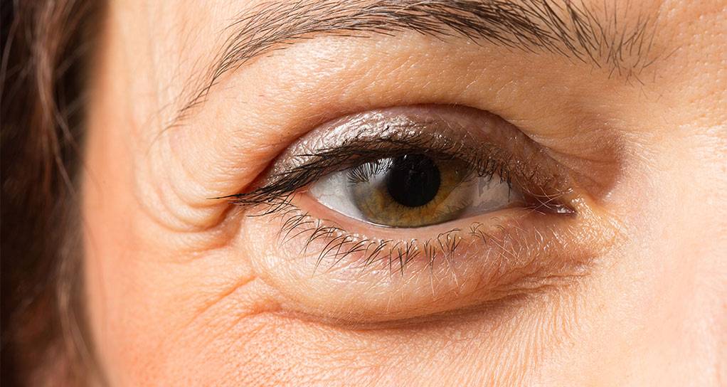 پف زیر چشم چیست؟ پف زیر چشم چیست؟