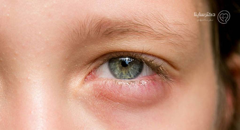 علت پف زیر چشم در کودکان چیست؟ علت پف زیر چشم در کودکان چیست؟