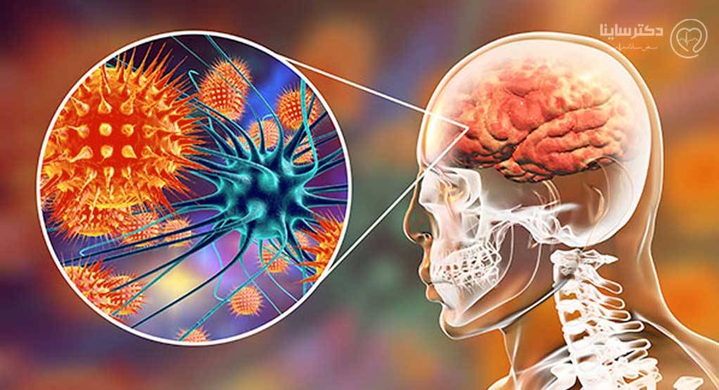 چقدر با بیماری آنسفالیت مغزی آشنا هستید؟ چقدر با بیماری آنسفالیت مغزی آشنا هستید؟