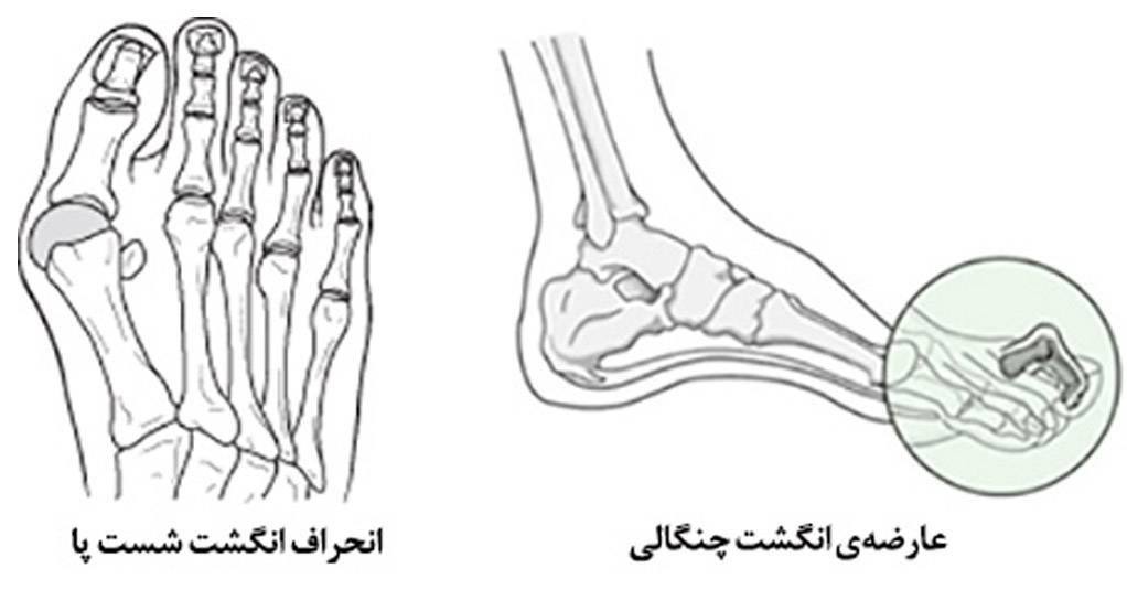 روماتیسم مفصلی پا