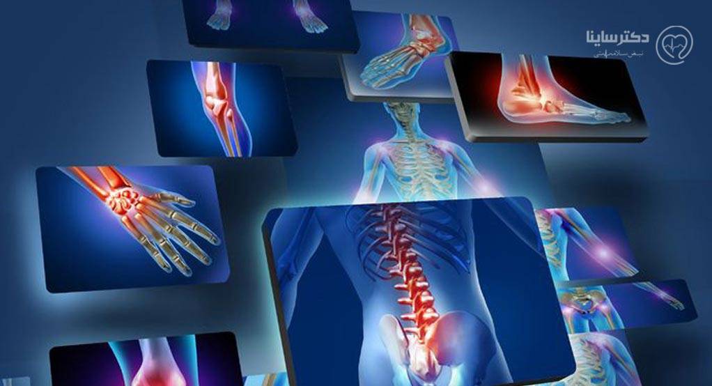 آرتریت روماتوئید یا روماتیسم مفصلی چیست و چه علائمی دارد؟ آرتریت روماتوئید یا روماتیسم مفصلی چیست و چه علائمی دارد؟