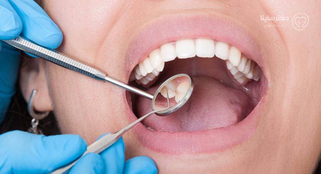 عوارض بریج دندان- دندان بریج