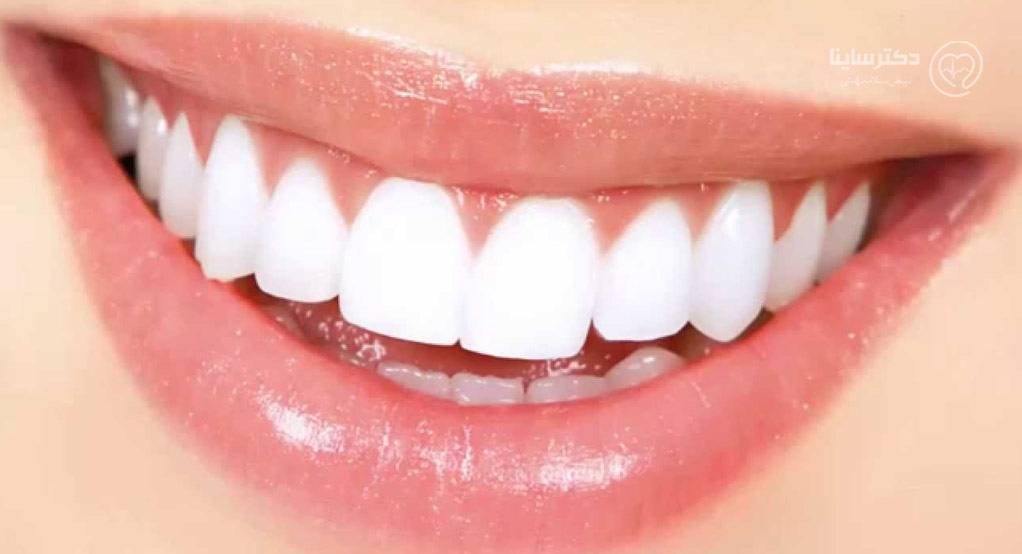 کاشت دندان به روش بریج