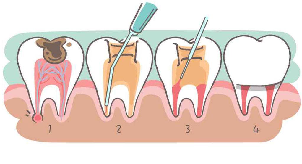 مراحل عصب کشی دندان