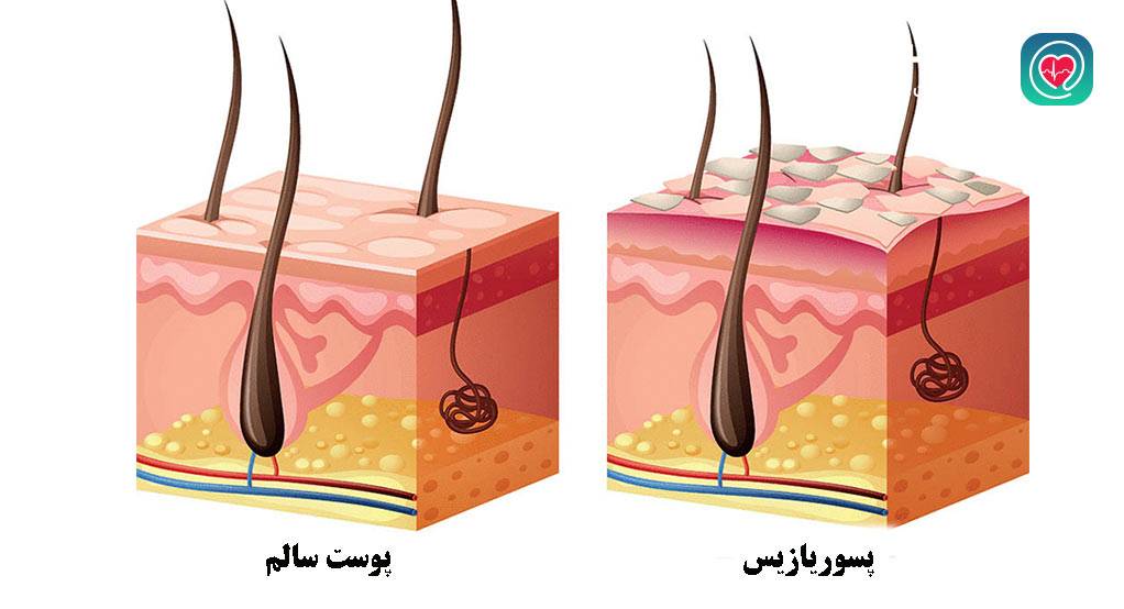 بیماری پسوریازیس پوستی 