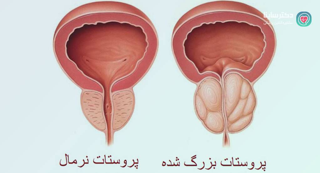 وجود خون در ادرار مردان 