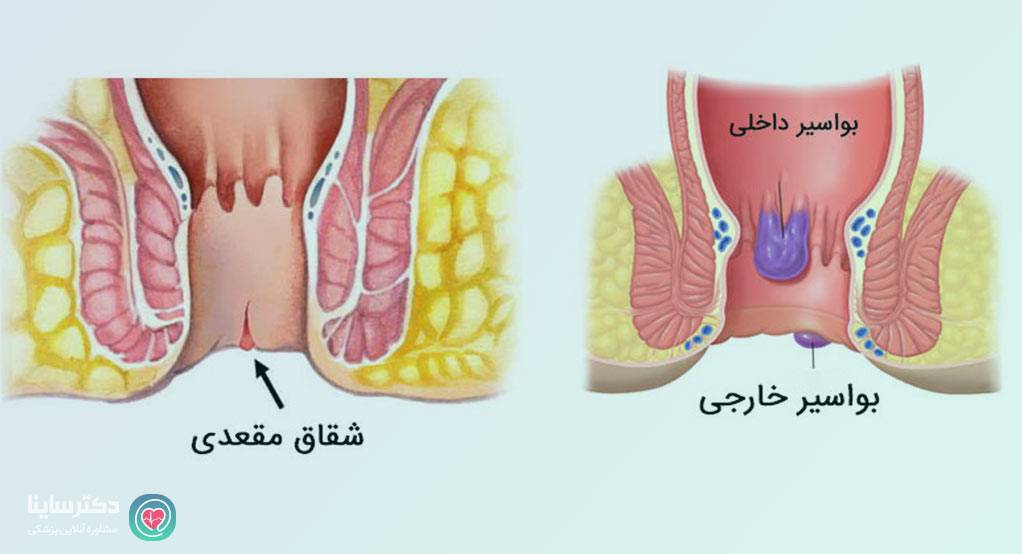 خطرات سکس مقعدی