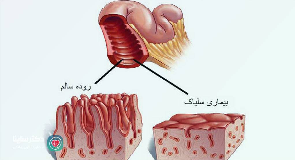 سلیاک چیست