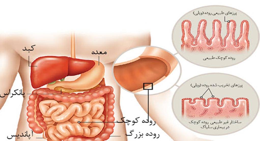 مصرف گلوتن در بیماران سلیاکی باعث آسیب روده کوچک میشود