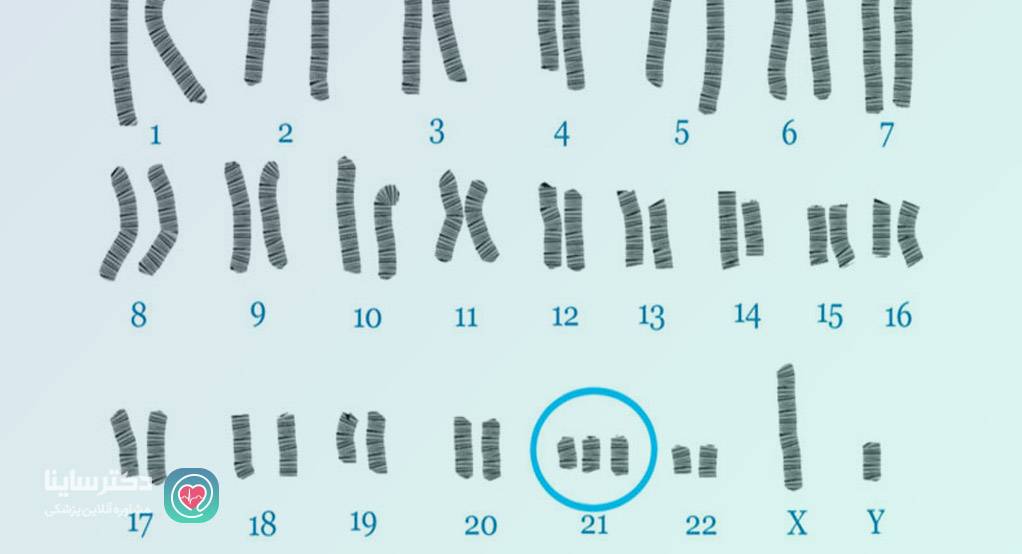 سندرم داون چیست عدد نرمال تریزومی 21