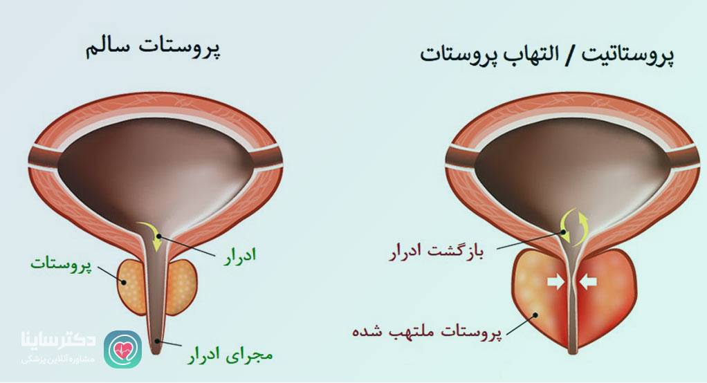 پروستاتیت چیست 