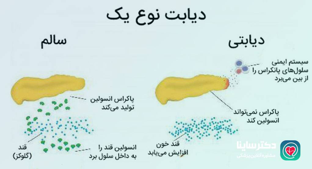  دیابت نوع یک چیست