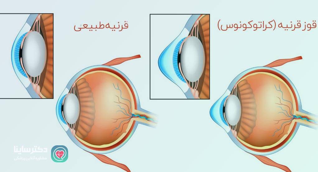 قوز قرنيه چشم چيست 