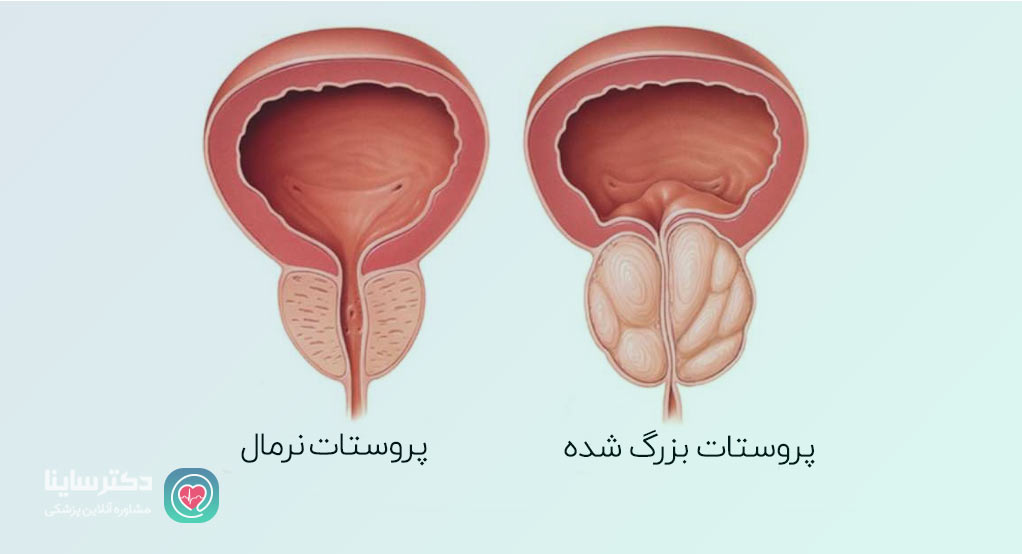 علت عفونت ادراری مکرر در مردان