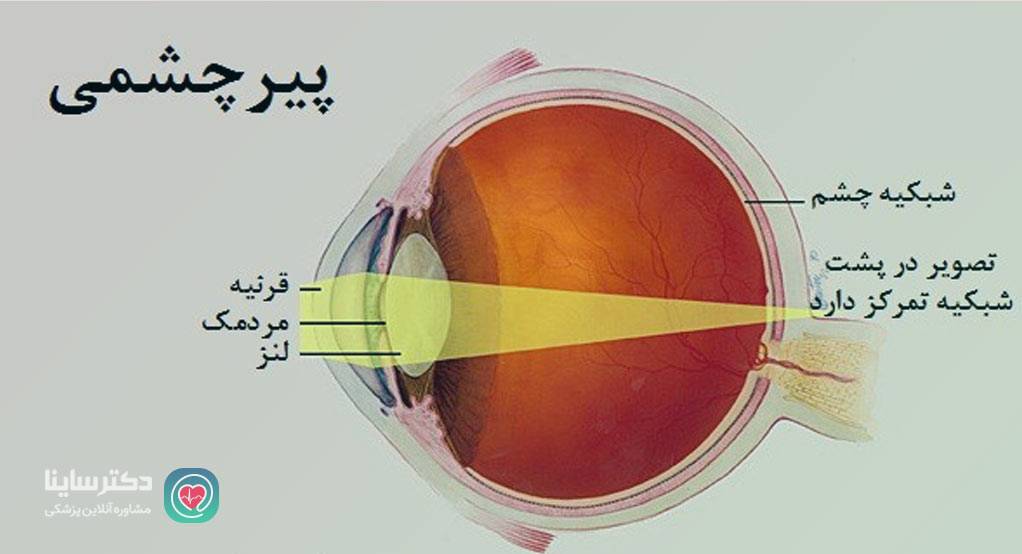 پیر چشمی چیست 