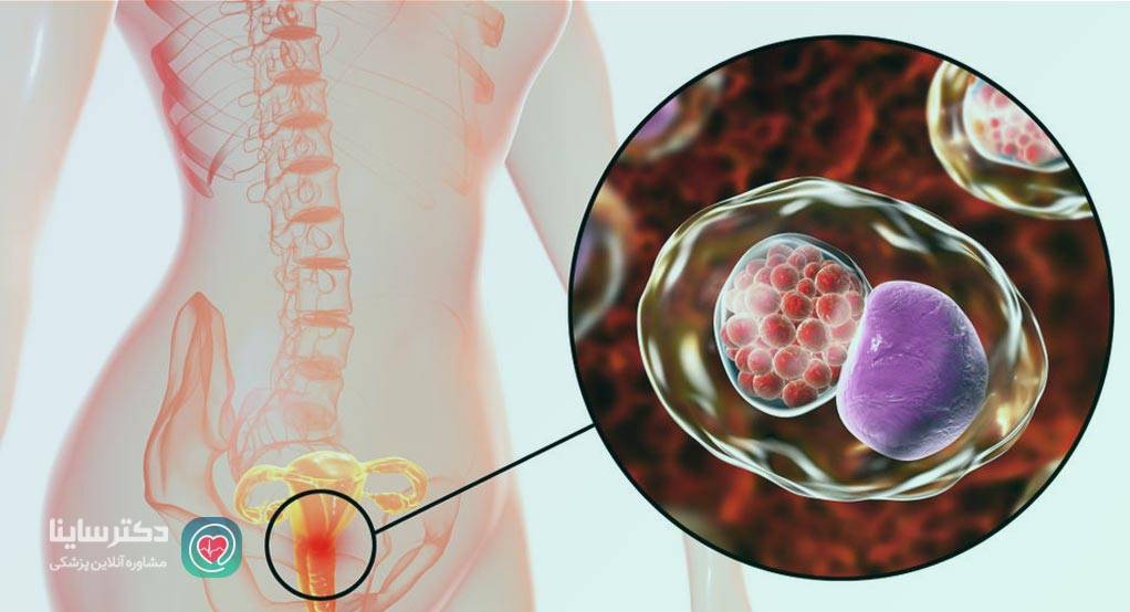 عفونت کلامیدیا چیست 