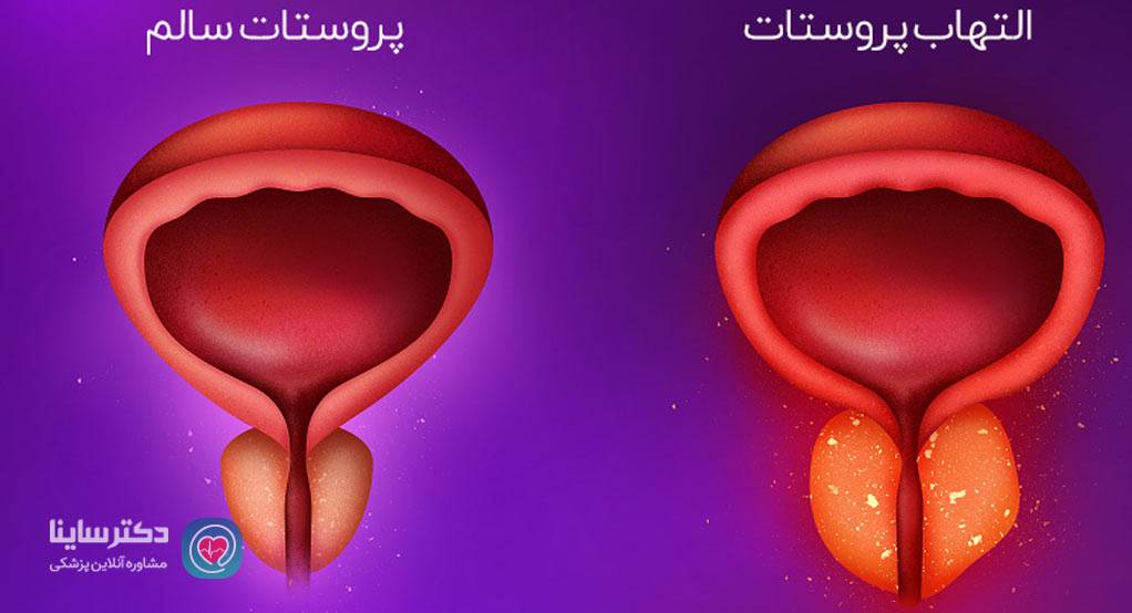 عفونت کلامیدیایی در مردان 