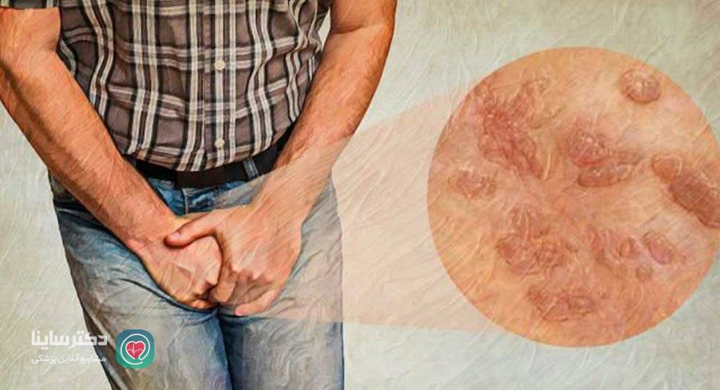 انواع بیماری های مقاربتی با عکس