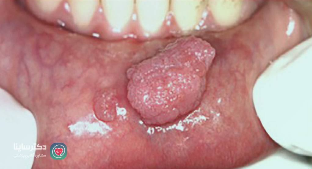  hpv در دهان