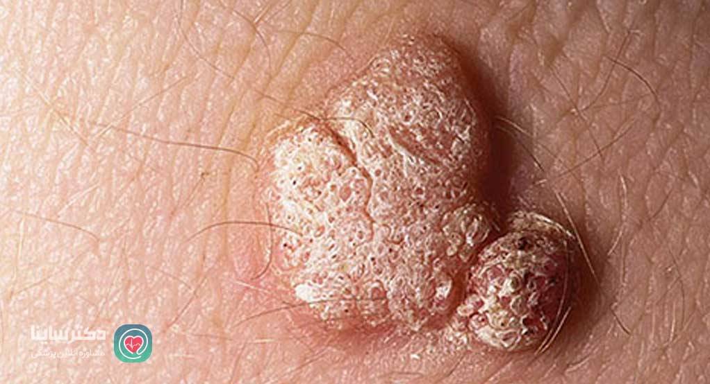 عکس ویروس hpv