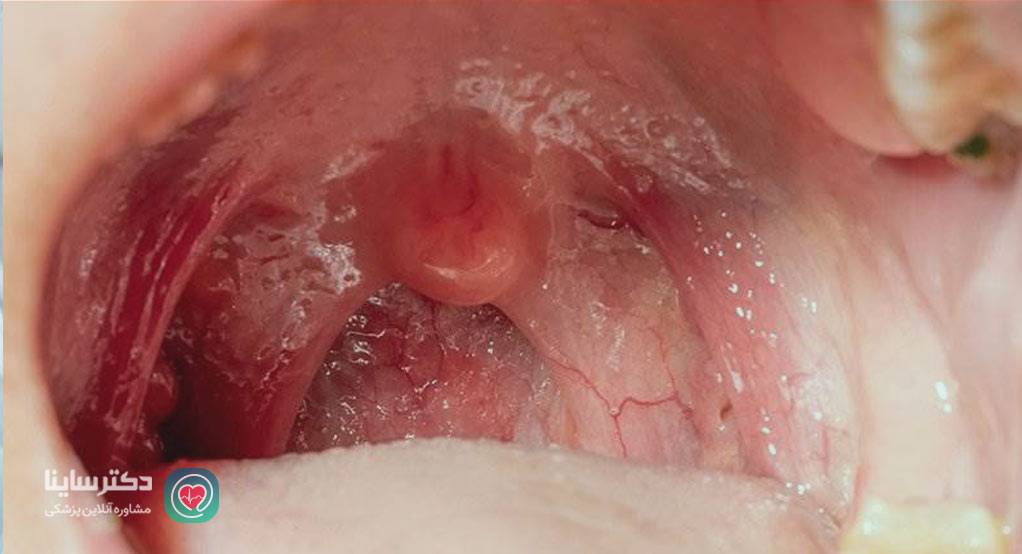 تيپ هاي خطرناك hpv