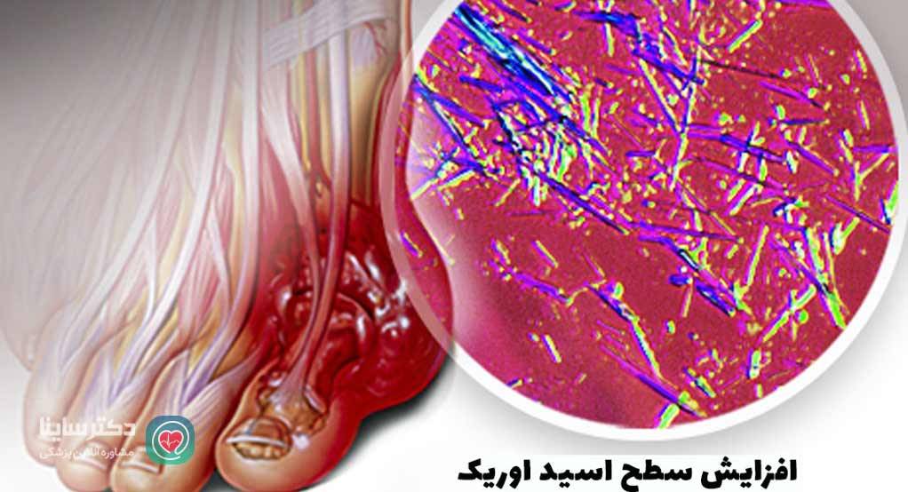 علائم نقرس شست پا 