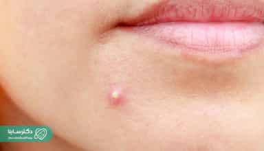کورک چیست؟ روش‌های قطعی درمان خانگی و دارویی کورک پوستی