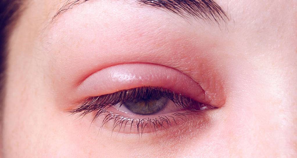 مراقبت های قبل و بعد از عمل شالازیون چشم