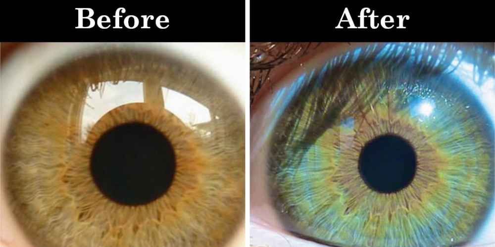 روش های نوین تغییر رنگ چشم