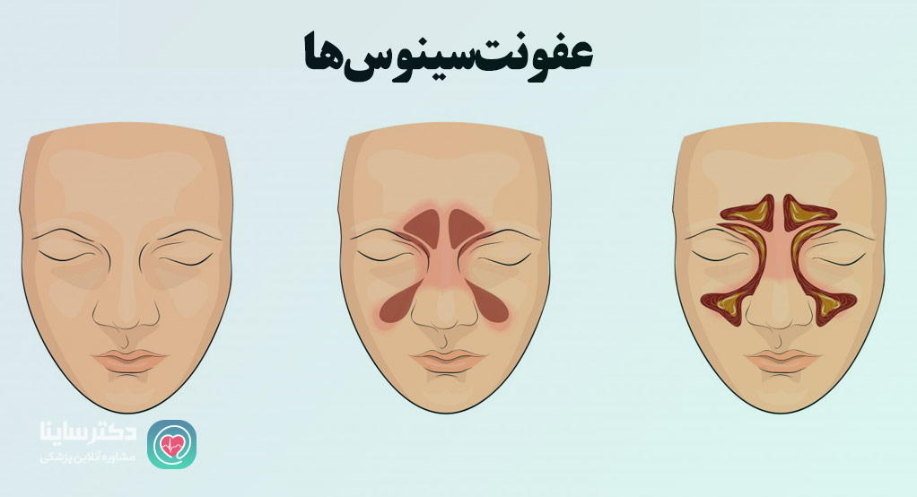 عفونت سینوس