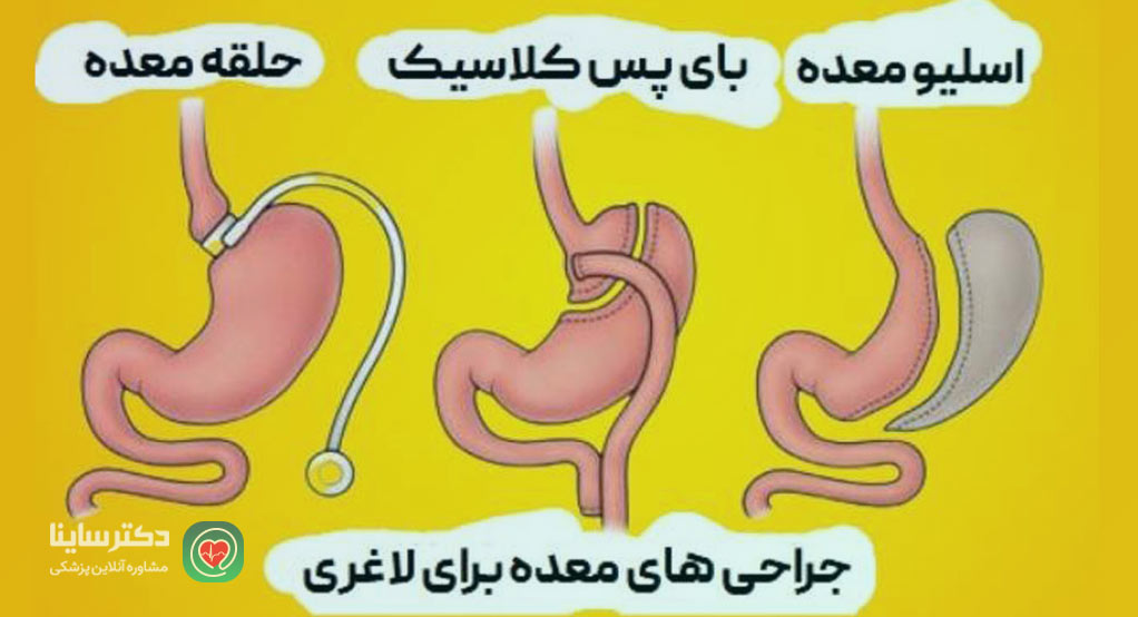 انواع جراحی چاقی