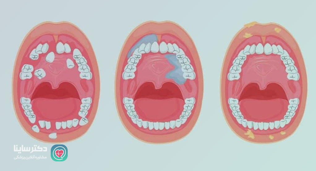 عکس سرطان دهان
