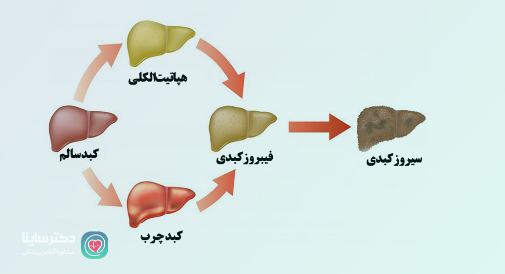 کبد چرب الکلی