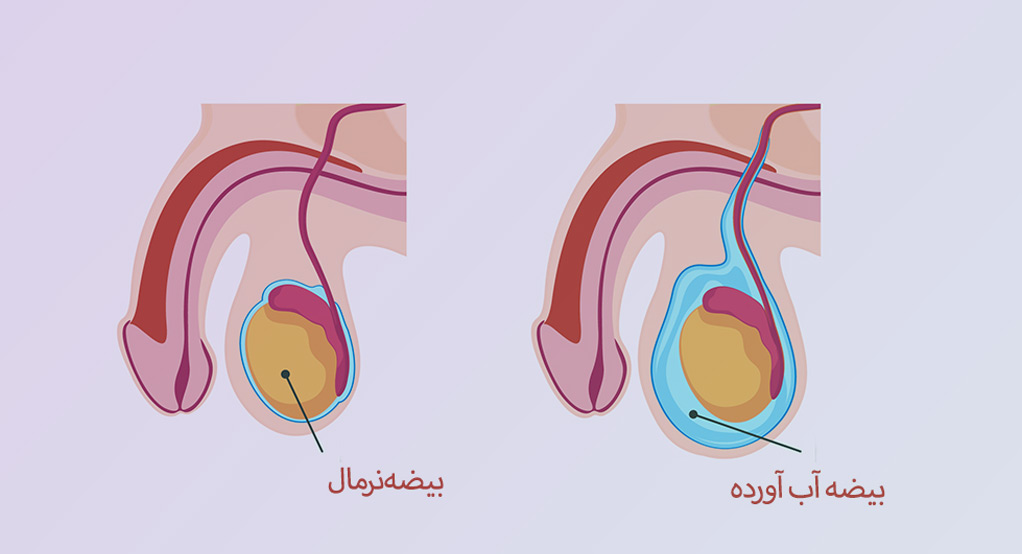 هیدروسل بیضه