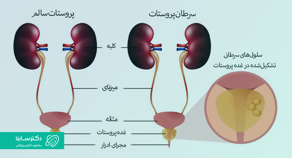  سرطان پروستات چیست