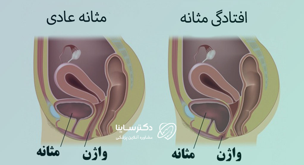 افتادگی مثانه 