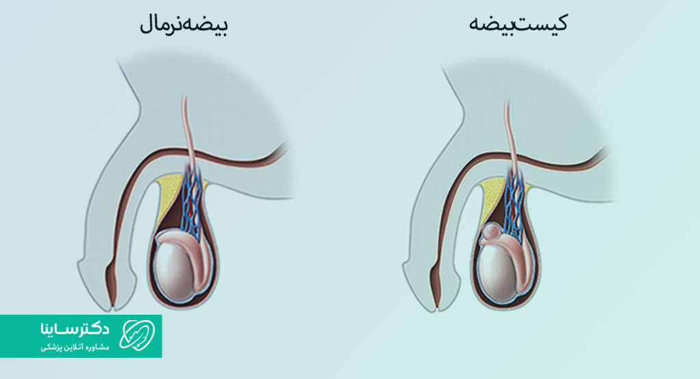 کیست بیضه