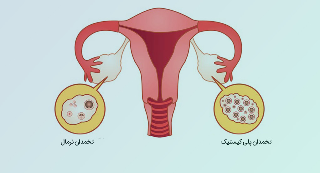 کیست تخمدان و بارداری