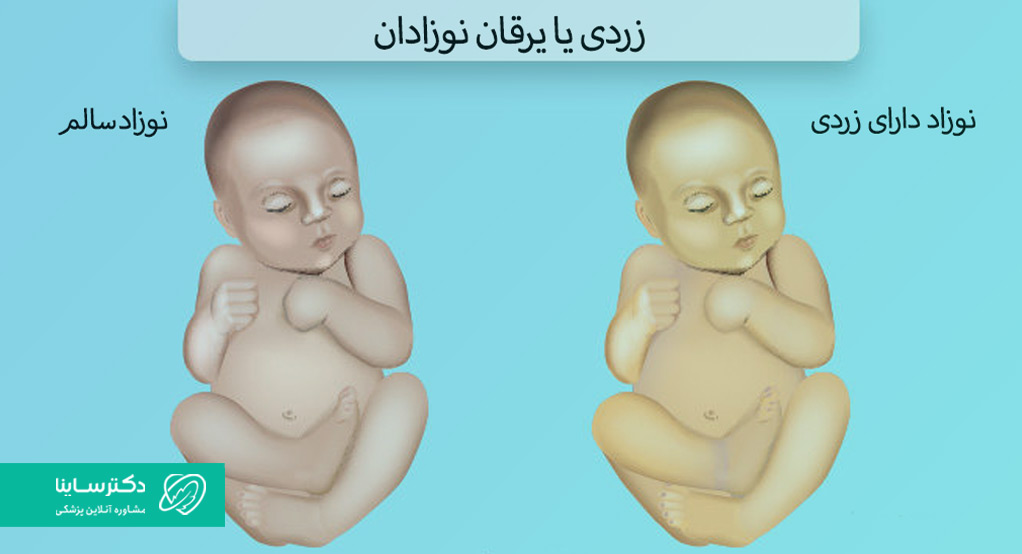 علائم زردی نوزاد 