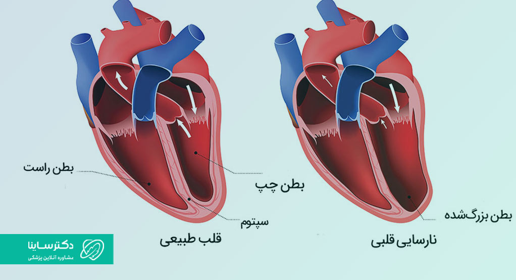  نارسایی قلبی بطن چپ