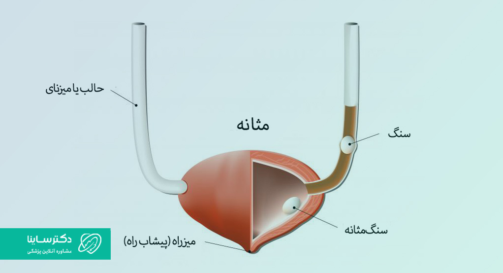 سنگ مثانه چیست