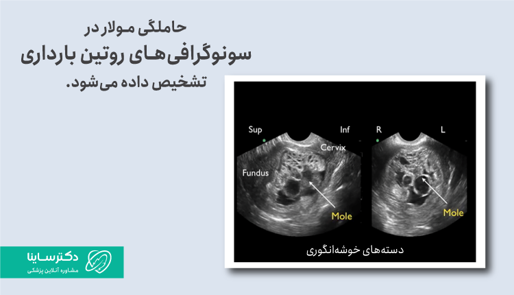 تشخیص بارداری مولار از طریق سونوگرافی