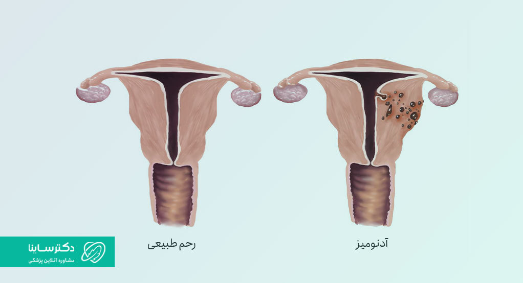 تفاوت رحم طبیعی و کیست رحم آدنومیوز